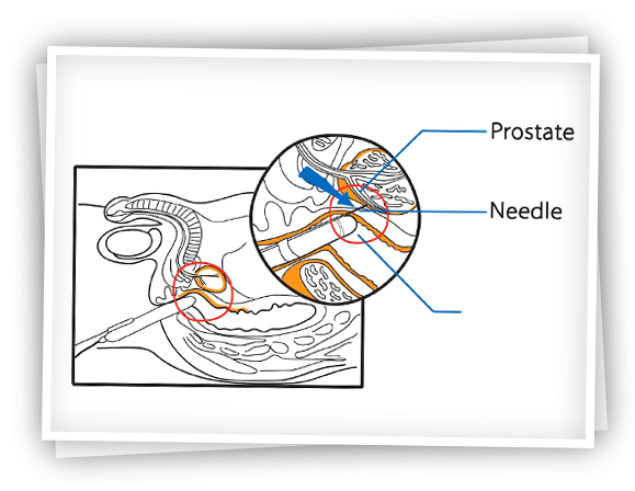 prostat-biyopsisi