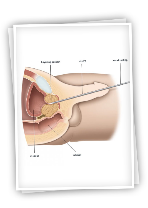 Benign Prostate Enlargement and Endoscopic Prostate Surgery – Dr. Tepeler