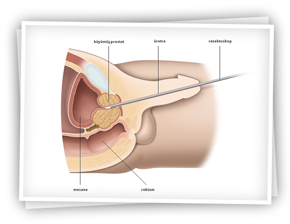 Transurethral Prostate Incision (TUIP) – Dr. Kadir Tepeler