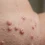 Genital Molluscum Contagiosum