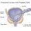 Transüretral Prostat İnsizyonu